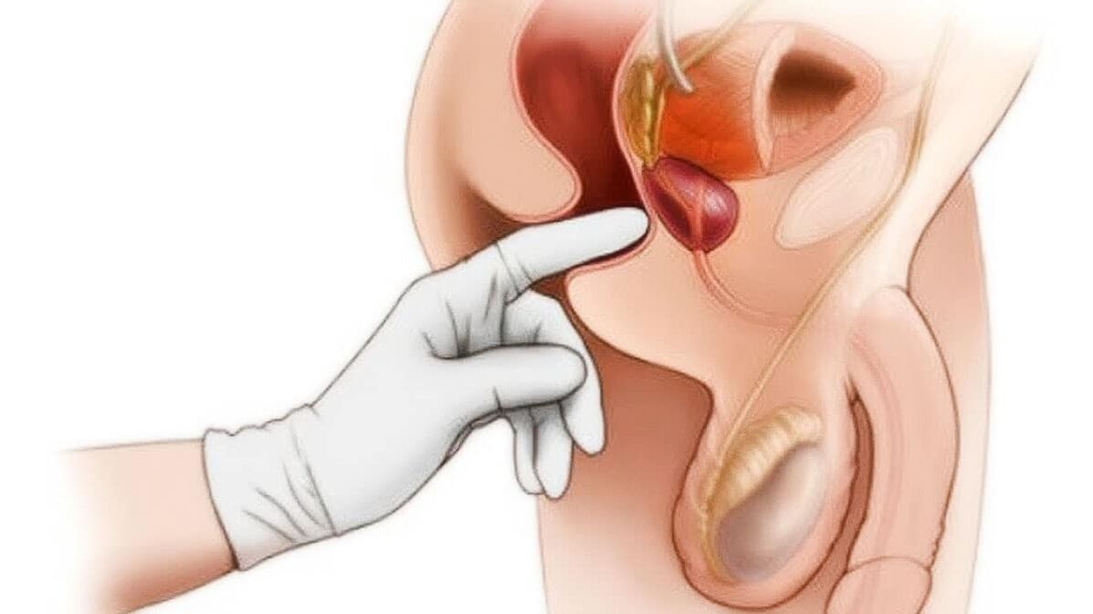 prostatīta diagnostika un ārstēšana ar ierīci