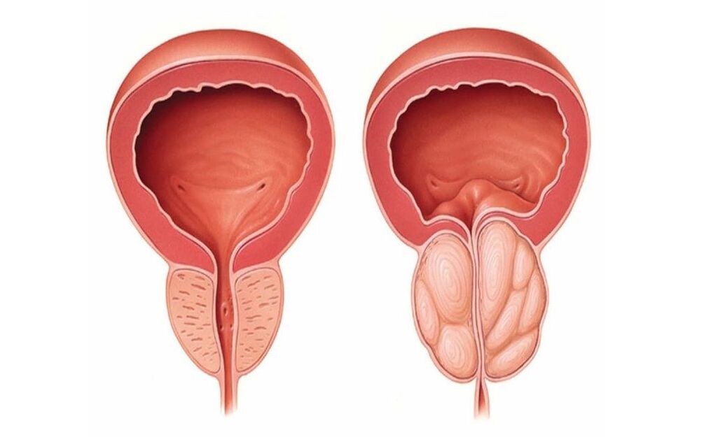 normāla un iekaisusi prostata
