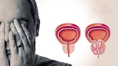 Prostatīta attīstības iemesli vīriešiem