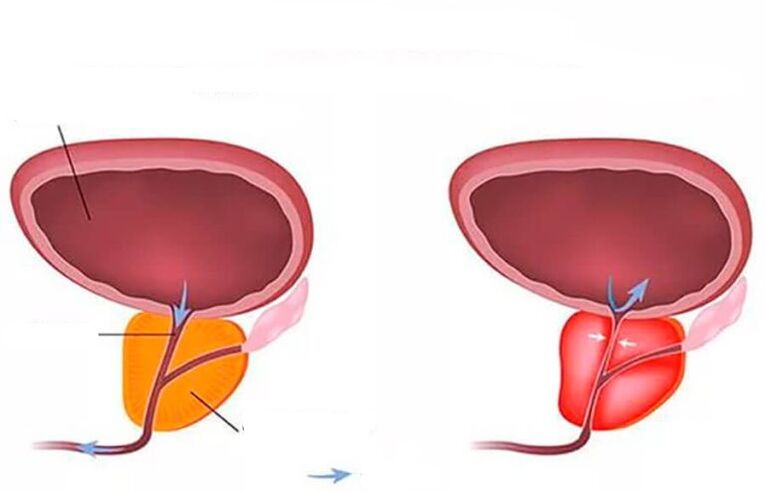 normāla un iekaisusi prostata