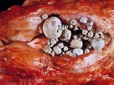 Akmeņi prostatas dziedzerī ar calculous prostatītu