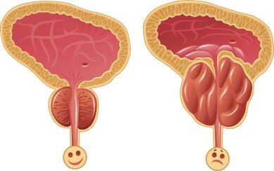 Veselīga un iekaisusi vīrieša prostata