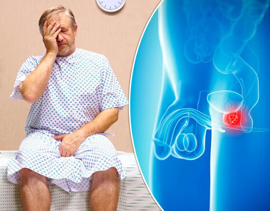 reflexoterapie și prostatita cancer de prostata simptome