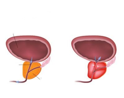 Normāla un iekaista prostata