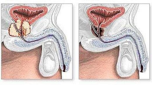 Pirms un pēc hroniska prostatīta ķirurģiskas ārstēšanas